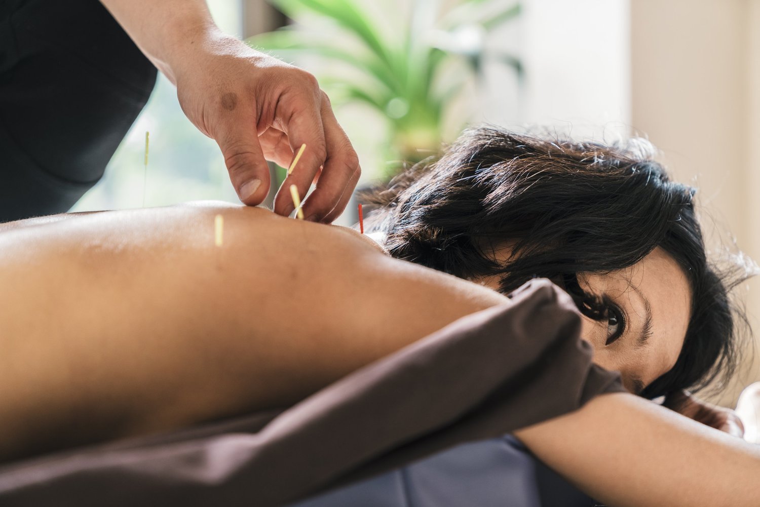 Acupuncture treatment for back and shoulder pain