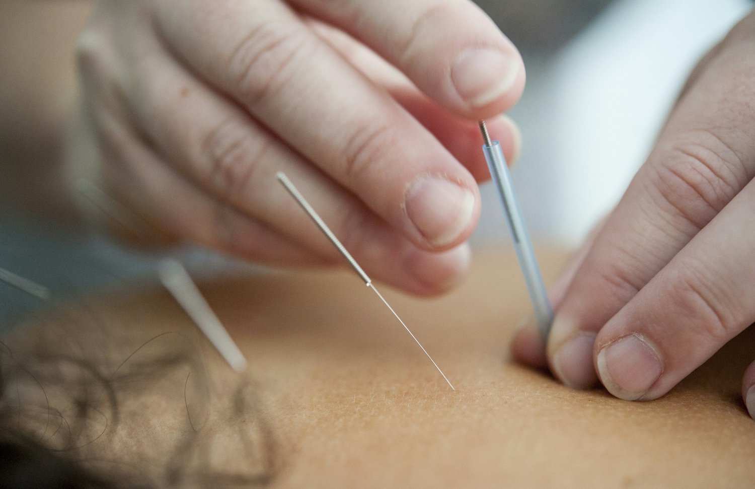 holistic approach to pain management - someone doing acupuncture